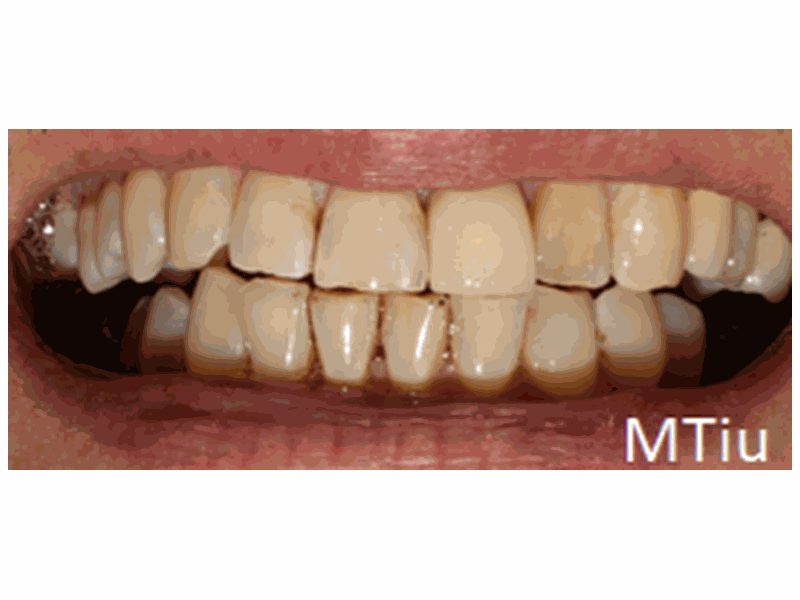 After Single Implant