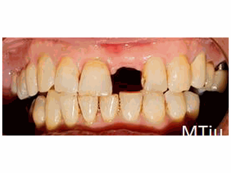 Before Single Implant