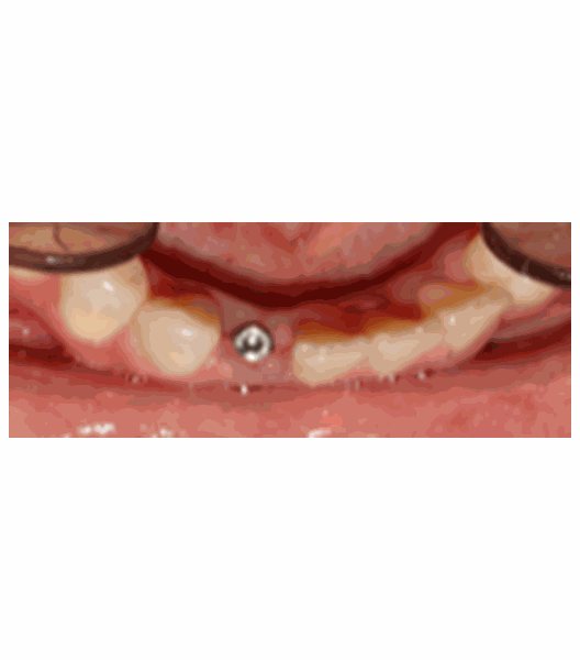 During Implants