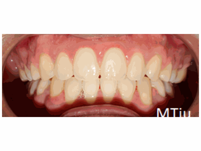 After Orthodontics