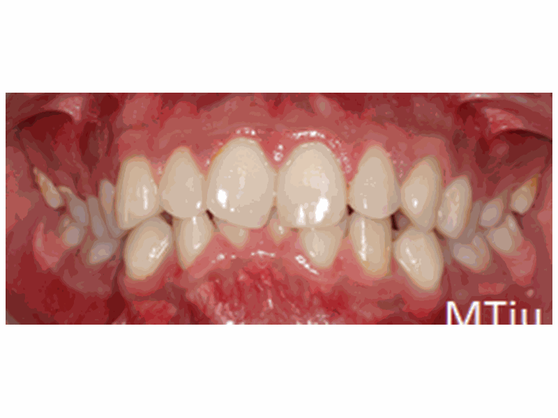 Before Orthodontics