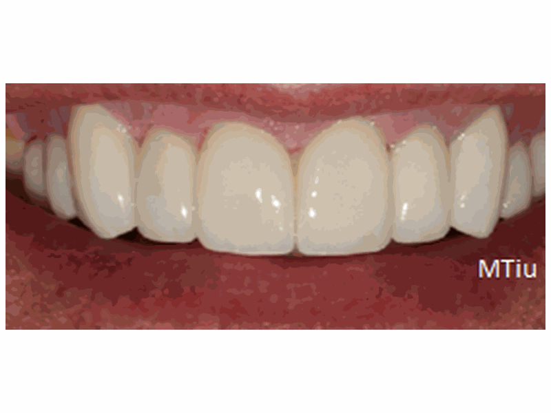 After Veneers