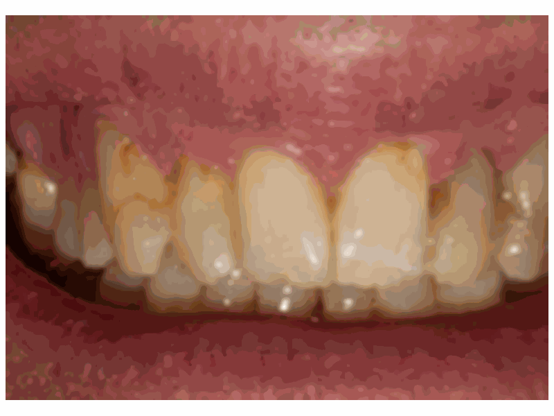 Before Veneers