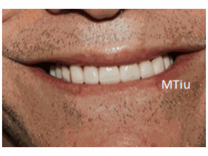 After Whitening