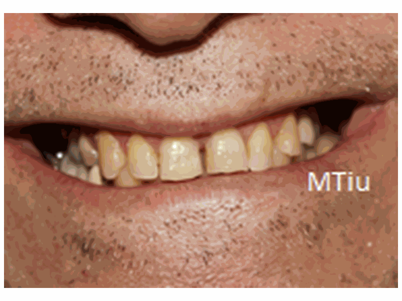 Before Whitening