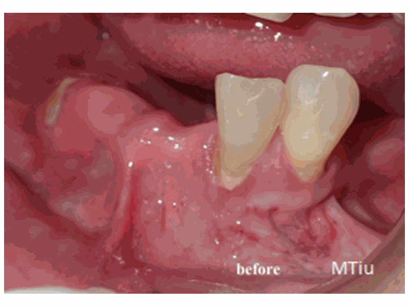 Before Gum Graft