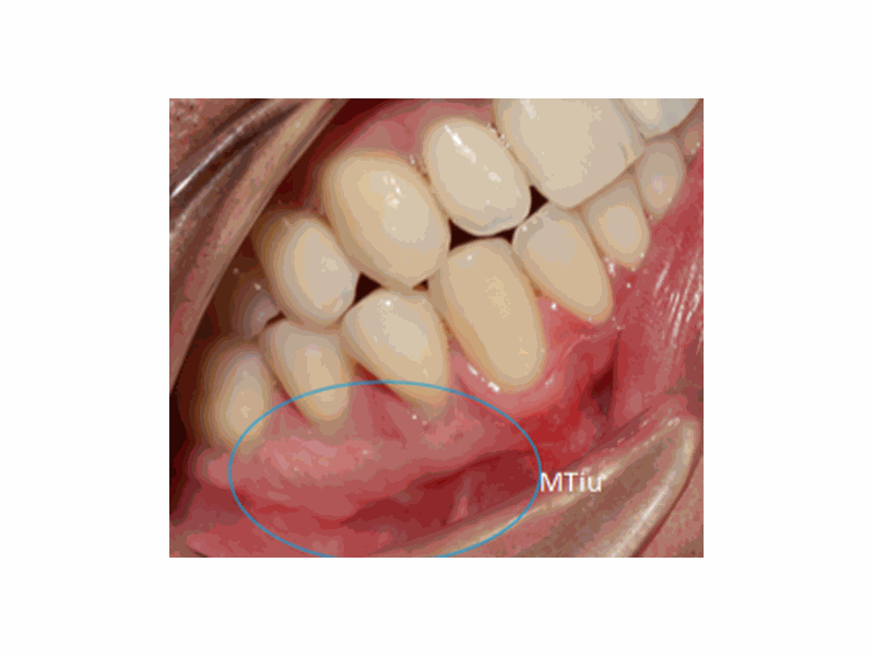After Tissue Graft