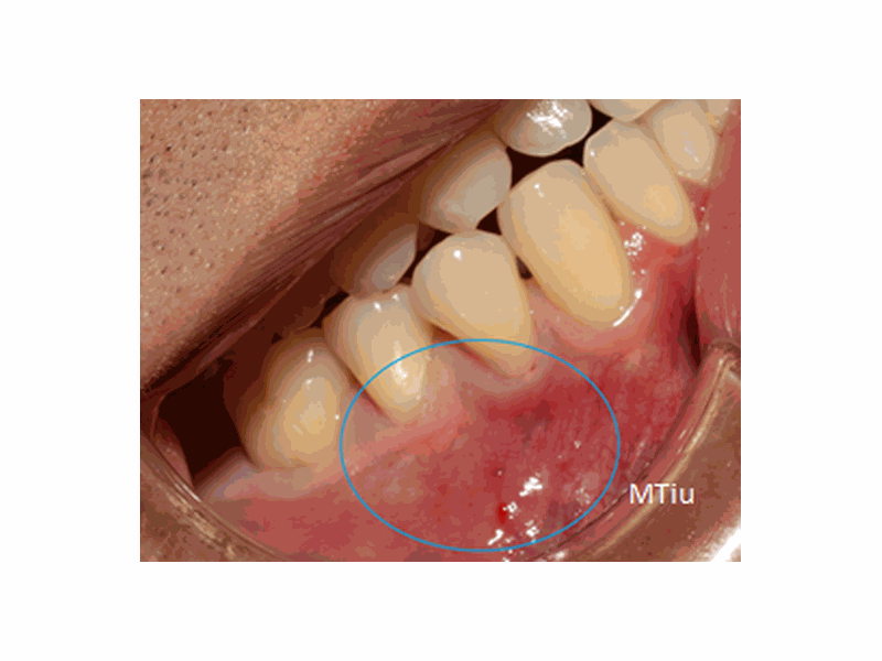 Before Tissue Graft